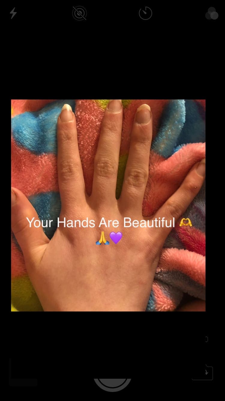 Todays Open Cut Healing!! 😁🙏🙏