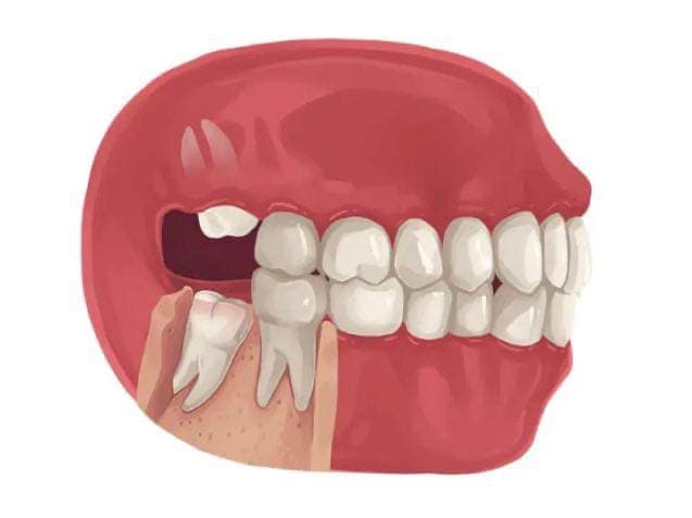 Wisdom teeth extractions